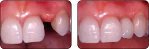 Before and after dental implants in Shady Spring, Lochgelly, and Bluefield, WV