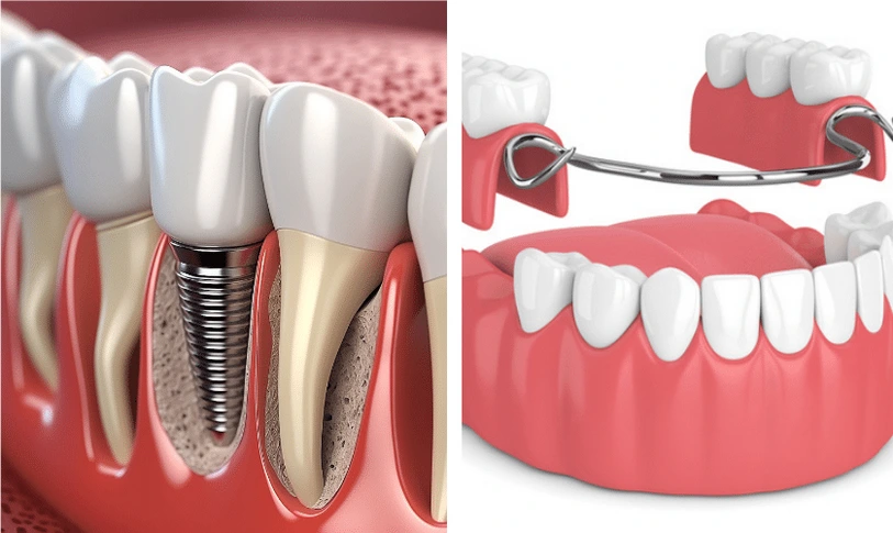 Dentures vs. implants in Shady Spring and Lochgelly