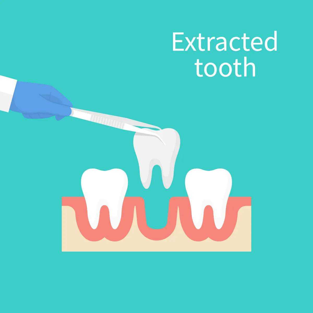 Tooth extractions in Shady Spring, Lochgelly, and Bluefield, WV, serve patients in Beckley, Princeton, Lewisburg, Oak Hill, Summersville, Fayetteville, Hinton, WV, Tazewell, Wytheville, Pearisburg, and Narrows, VA
