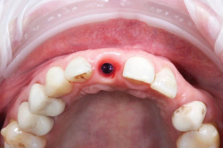 Tooth Extraction in Shady Spring and Lochgelly, WV