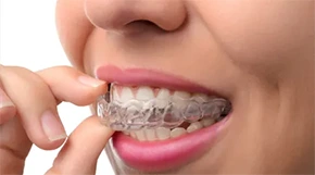 Invisalign treatment in Shady Spring, Lochgelly, Beckley, Princeton, Lewisburg, Oak Hill, Summersville, Fayetteville, and Hinton, WV.
