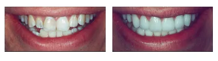 Cosmetic dentists near me in Shady Spring, Lochgelly, Beckley, Princeton, Lewisburg, Oak Hill, Summersville, Fayetteville, and Hinton, WV.
