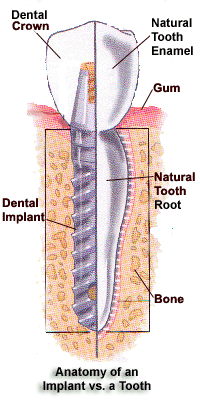 Dental restoration in Shady Spring, Lochgelly, and Bluefield, WV